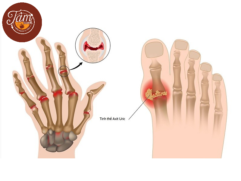 chế độ ăn dự phòng bệnh gout